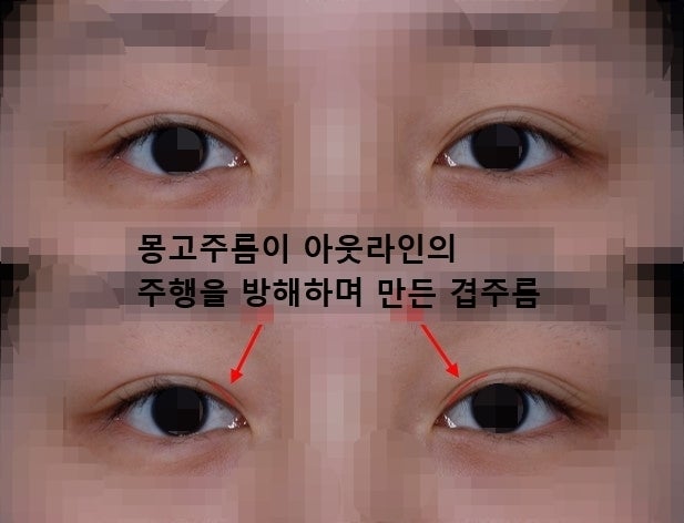 쌍수 아웃라인에 대하여...