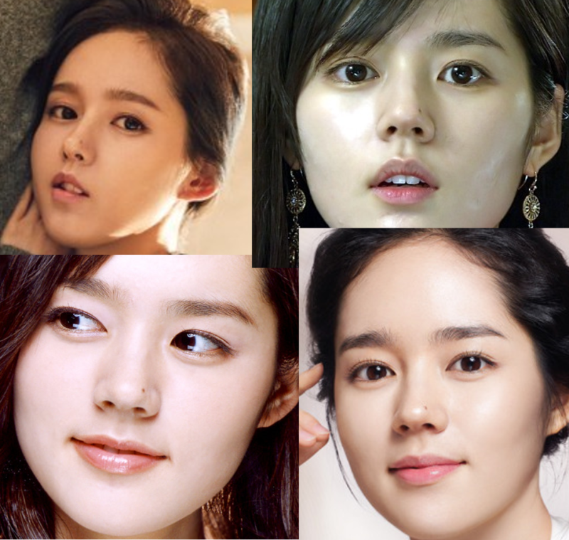 쌍수 아웃라인에 대하여... 사진 2
