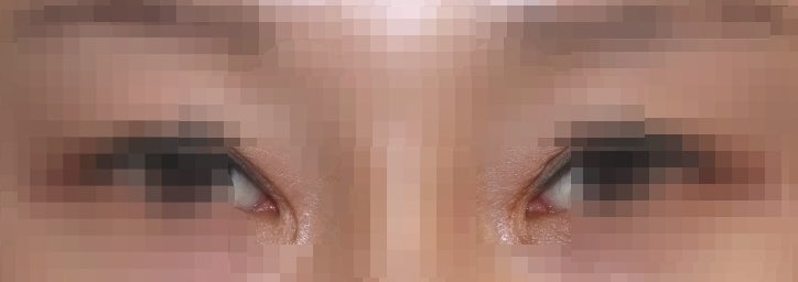 쌍수 아웃라인에 대하여... 사진 5