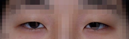 짝눈교정에 대하여...