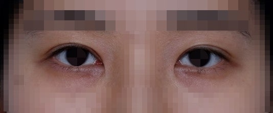 짝눈교정에 대하여...