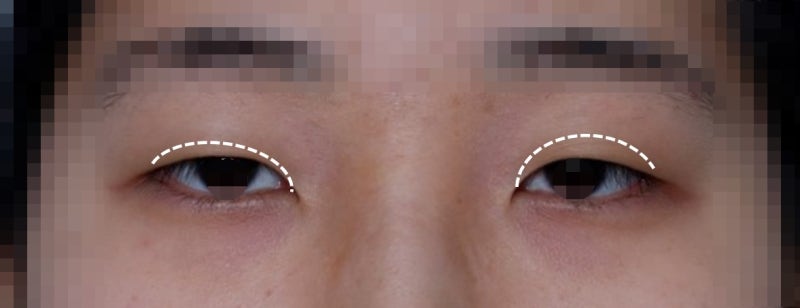 짝눈교정에 대하여... 사진 3