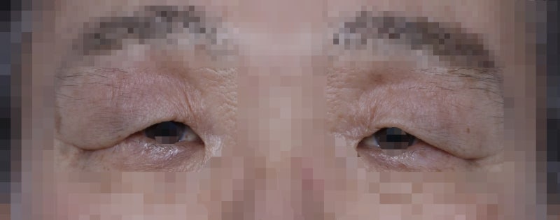 나이 들며 생기는 눈처짐...
