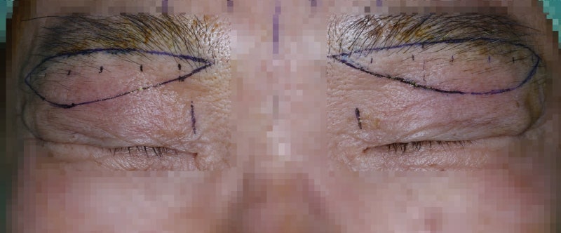 나이 들며 생기는 눈처짐... 사진 2