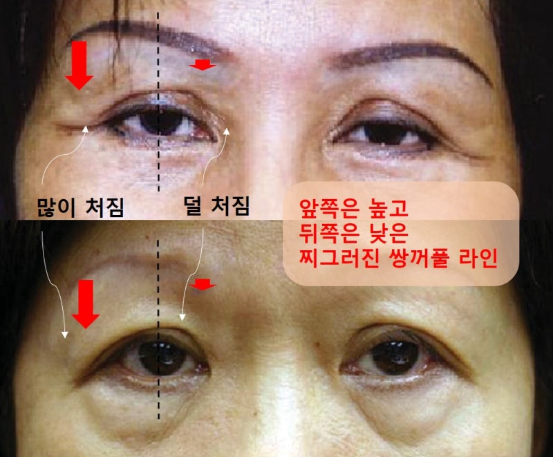 큰 쌍꺼풀, 높은 쌍꺼풀, 하이 폴드 (1편 : 재앙의 시작) 사진 4