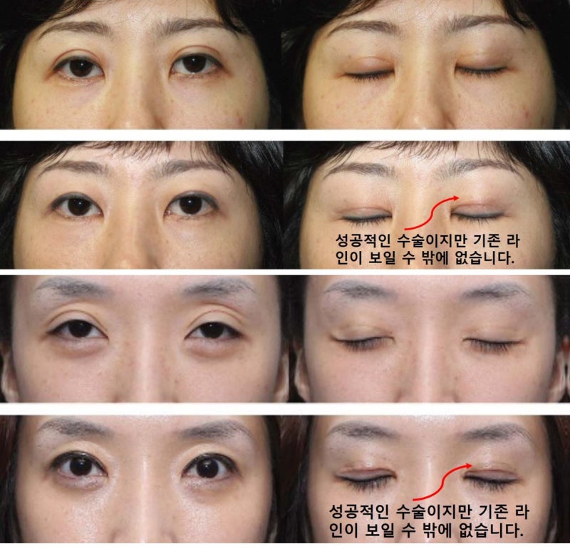 큰 쌍꺼풀, 높은 쌍꺼풀, 하이 폴드 (1편 : 재앙의 시작) 사진 6