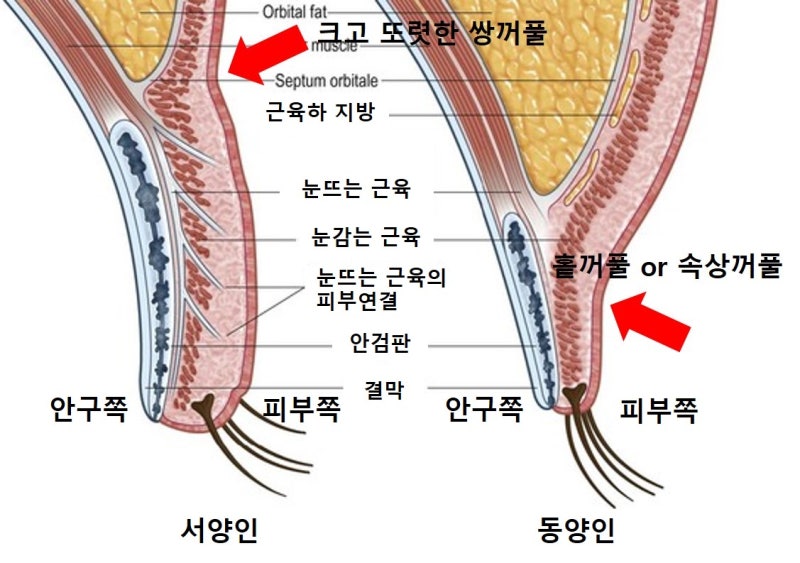 큰 쌍꺼풀, 높은 쌍꺼풀, 하이 폴드 (1편 : 재앙의 시작)