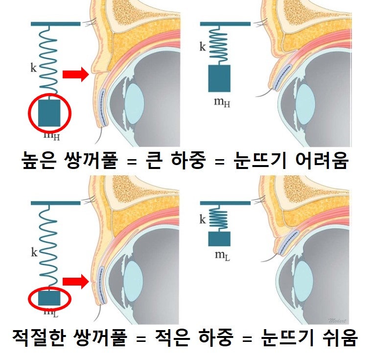 큰 쌍꺼풀, 높은 쌍꺼풀, 하이 폴드 (1편 : 재앙의 시작) 사진 2