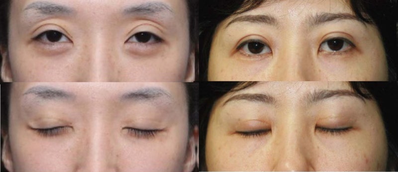 큰 쌍꺼풀, 높은 쌍꺼풀, 하이 폴드 (1편 : 재앙의 시작) 사진 3