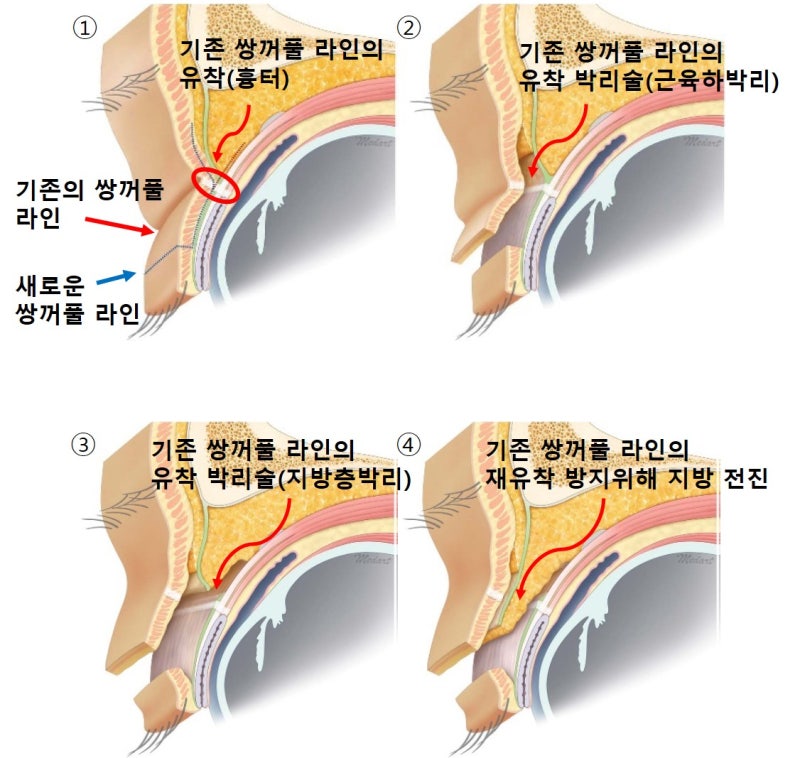 큰 쌍꺼풀, 높은 쌍꺼풀, 하이 폴드 (1편 : 재앙의 시작) 사진 5