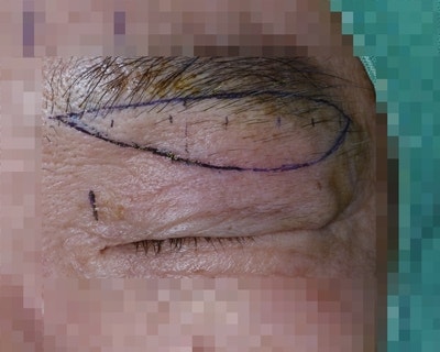 큰쌍꺼풀, 높은쌍꺼풀, 하이폴드 (2편 : 자연스럽게 크게) 사진 2