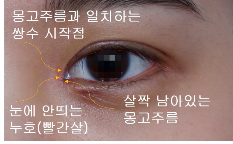 쌍꺼풀 라인의 종류 (인라인, 인아웃라인, 아웃라인)