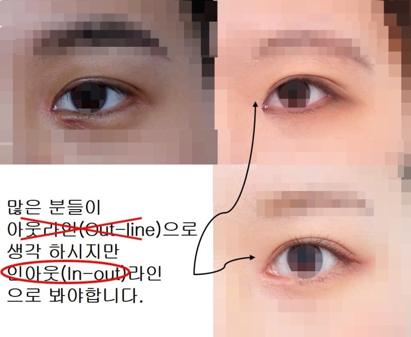 쌍꺼풀 라인의 종류 (인라인, 인아웃라인, 아웃라인) 사진 5