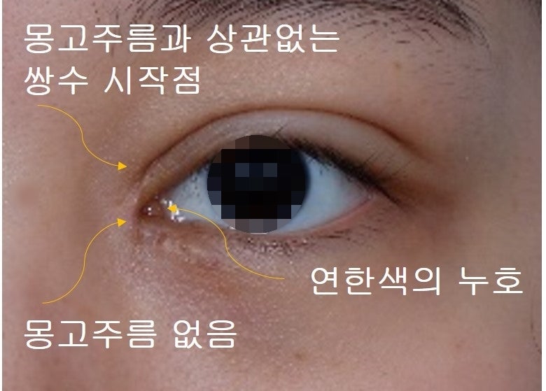 쌍꺼풀 라인의 종류 (인라인, 인아웃라인, 아웃라인) 사진 6