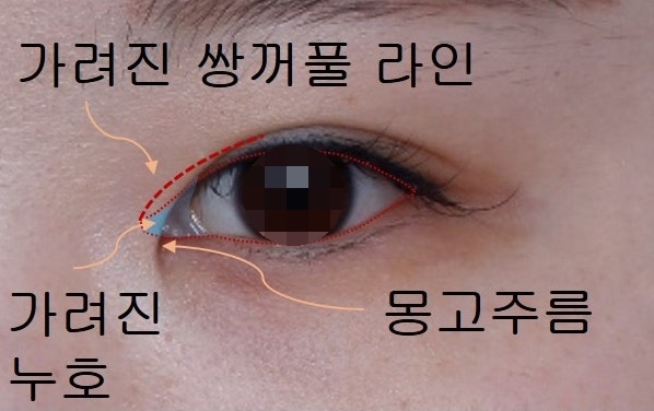 쌍꺼풀 라인의 종류 (인라인, 인아웃라인, 아웃라인) 사진 2
