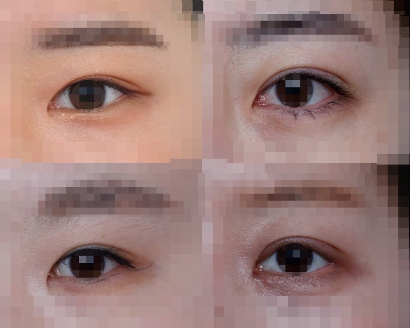 쌍꺼풀 라인의 종류 (인라인, 인아웃라인, 아웃라인) 사진 3