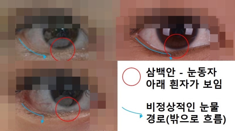 뒤트임, 밑트임에 대하여...