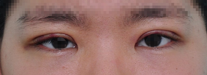 짝눈교정 없이 짝눈을 교정할 수 있을까? 사진 3