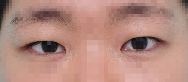 짝눈교정 없이 짝눈을 교정할 수 있을까?