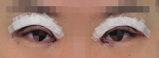쌍꺼풀수술 후 발생하는 부기 및 관리 사진 6