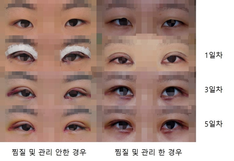 쌍꺼풀수술 후 발생하는 부기 및 관리 사진 3