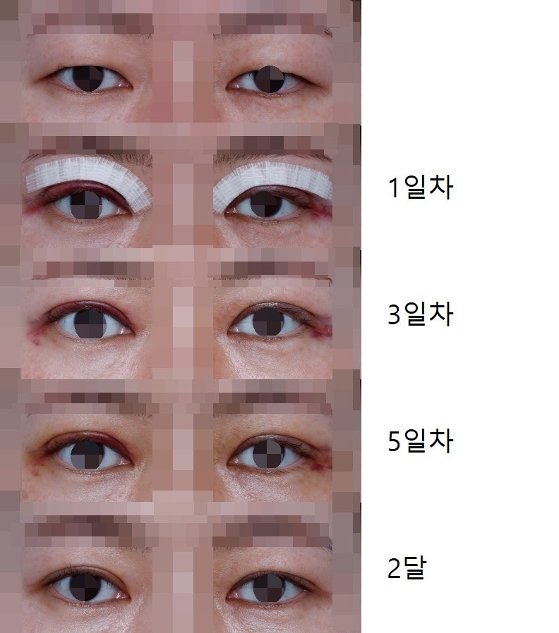 쌍꺼풀수술 후 발생하는 부기 및 관리