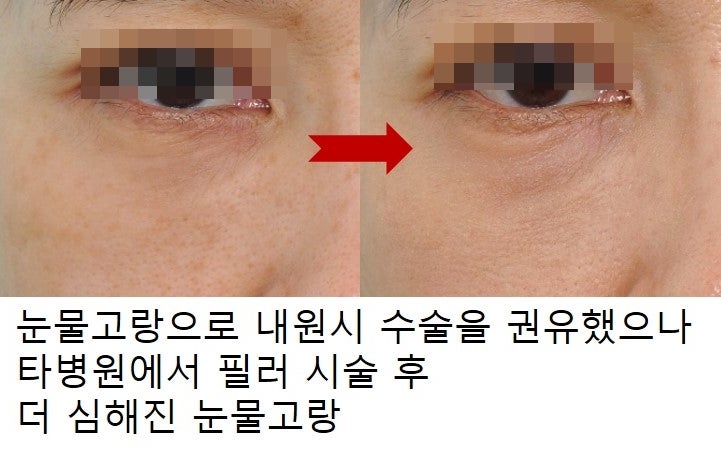 하안검 필러? 지방이식? 에 대하여... 사진 4