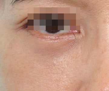 하안검 필러? 지방이식? 에 대하여... 사진 5
