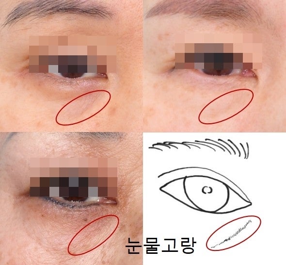 하안검 필러? 지방이식? 에 대하여...