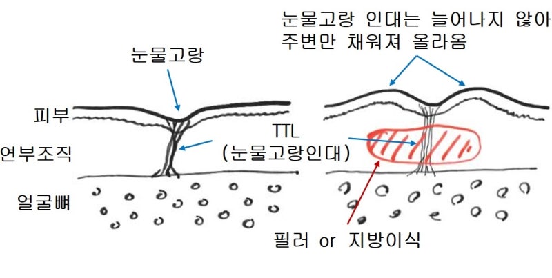 하안검 필러? 지방이식? 에 대하여... 사진 3
