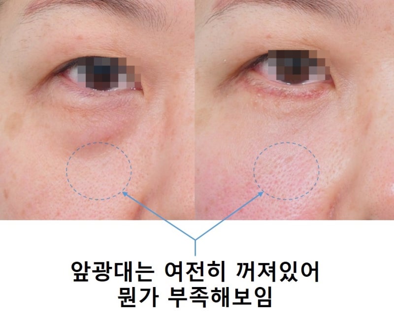 지방제거? 지방재배치? 생기발랄한 하안검을 찾아서... 사진 4