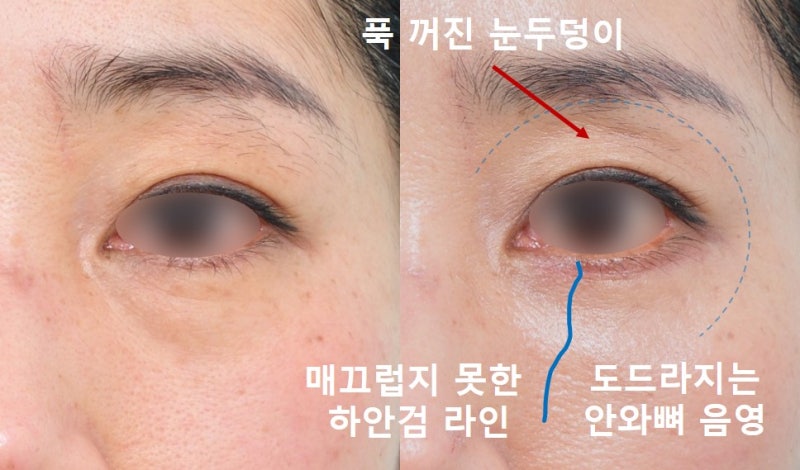 <하안검 2편> 지방제거? 지방재배치? 생기발랄한 하안검을 찾아서...