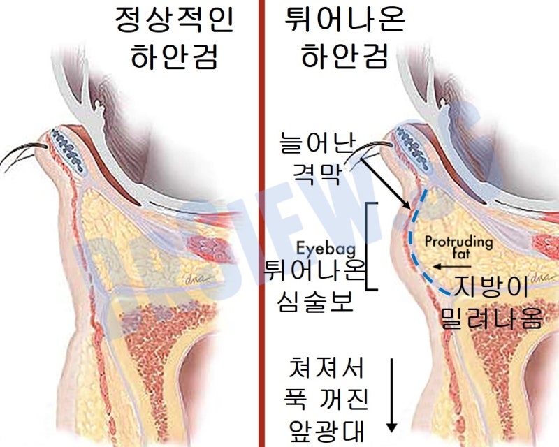 지방제거? 지방재배치? 생기발랄한 하안검을 찾아서... 사진 2