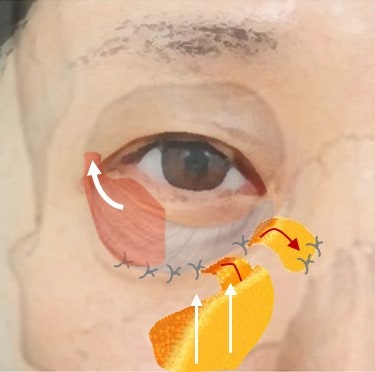 지방재배치+격막보강+앞광대리프팅 까지 한번에 제대로... 사진 6