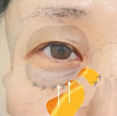 지방재배치+격막보강+앞광대리프팅 까지 한번에 제대로... 사진 5