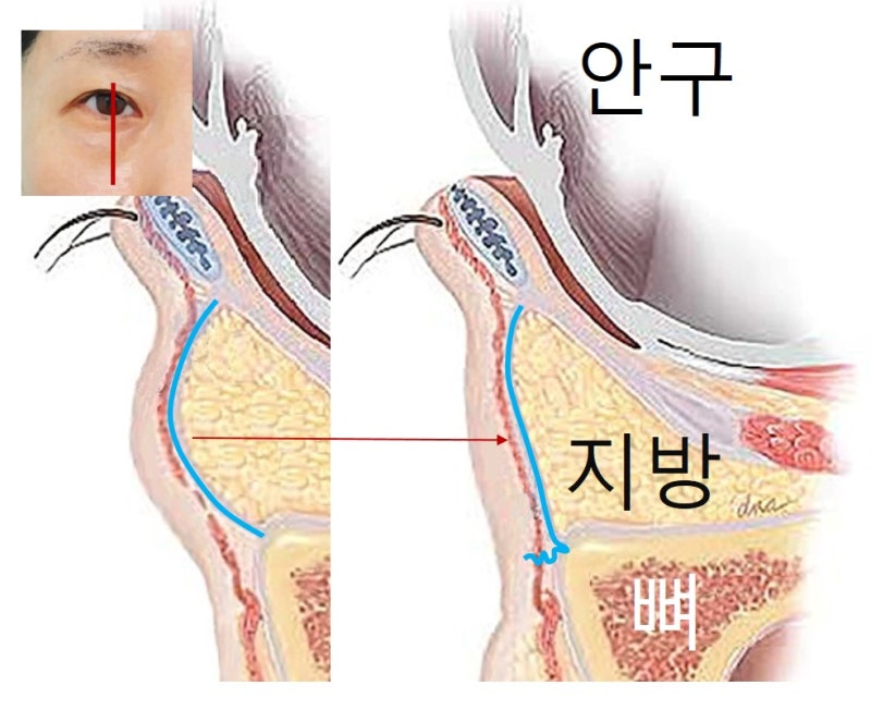 <하안검3편> 지방재배치+격막보강+앞광대리프팅 까지 한번에 제대로...