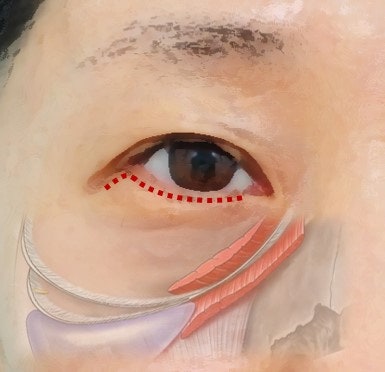 지방재배치+격막보강+앞광대리프팅 까지 한번에 제대로...