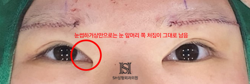 #1 눈썹하거상 수술, 왜 윗트임을 함께 해야 하는가 사진 8