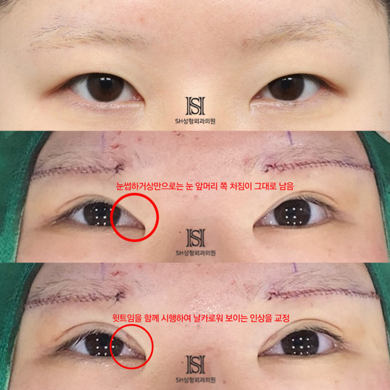 #1 눈썹하거상 수술, 왜 윗트임을 함께 해야 하는가 사진 11