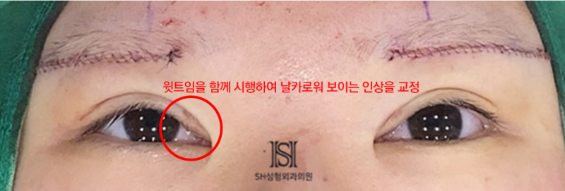 #1 눈썹하거상 수술, 왜 윗트임을 함께 해야 하는가 사진 9
