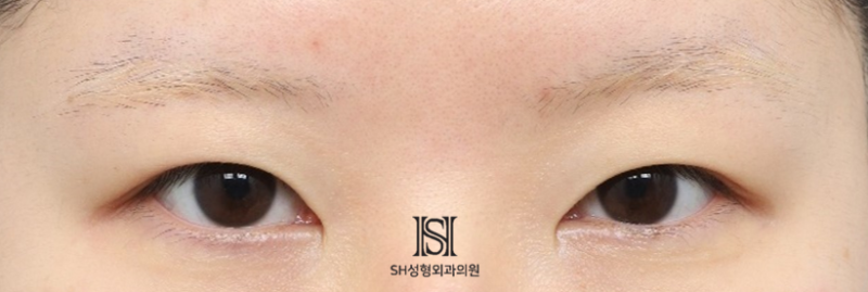 #1 눈썹하거상 수술, 왜 윗트임을 함께 해야 하는가 사진 7