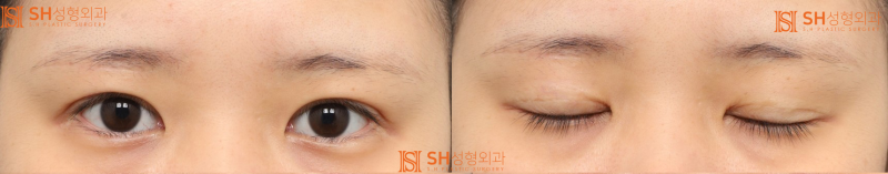 #2 눈썹하거상으로 비대칭 눈 교정 사진 2