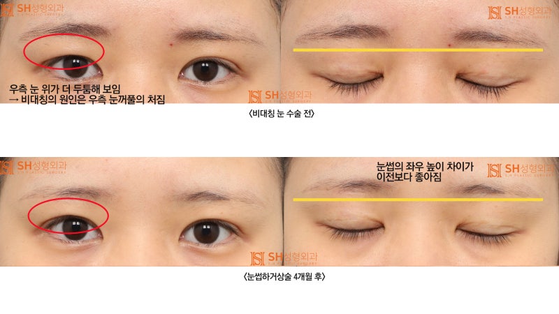 #2 눈썹하거상으로 비대칭 눈 교정