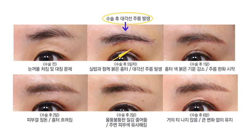 #3 눈썹하거상 흉터는 어떻게 될까?