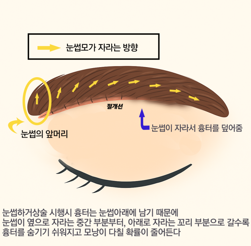 #3 눈썹하거상 흉터는 어떻게 될까?