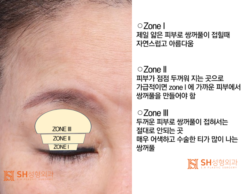 #4 상안검 수술? 상안검 실패의 원인과 분석 사진 2