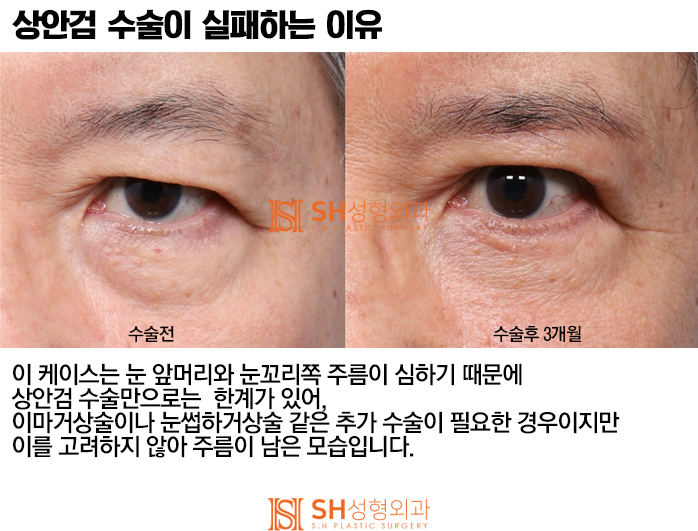 #4 상안검 수술? 상안검 실패의 원인과 분석 사진 6
