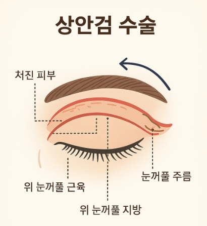 #4 상안검 수술? 상안검 실패의 원인과 분석