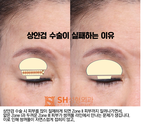 #4 상안검 수술? 상안검 실패의 원인과 분석 사진 3