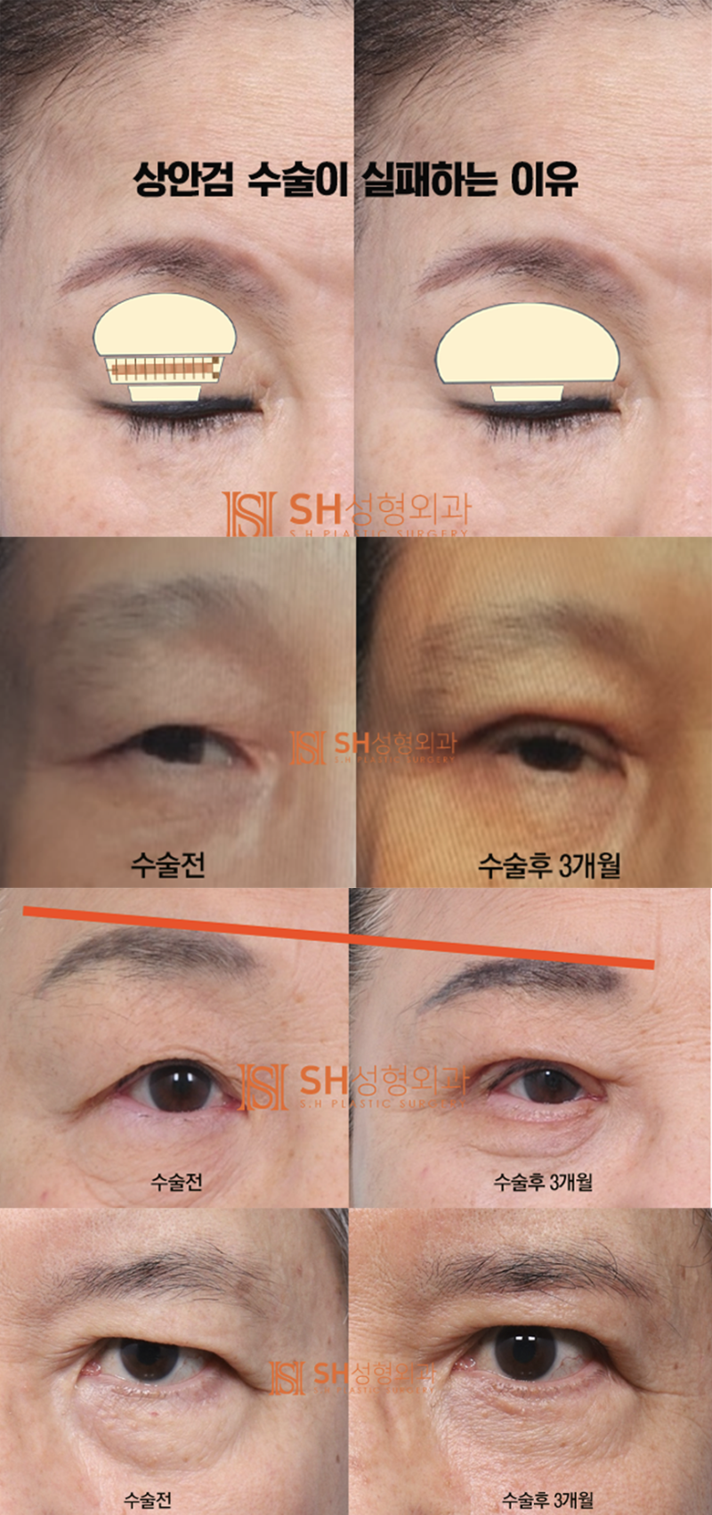 #4 상안검 수술? 상안검 실패의 원인과 분석 사진 7